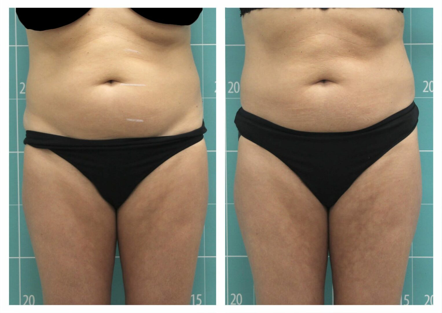 Tratamento da gordura abdominal | 3 sessões