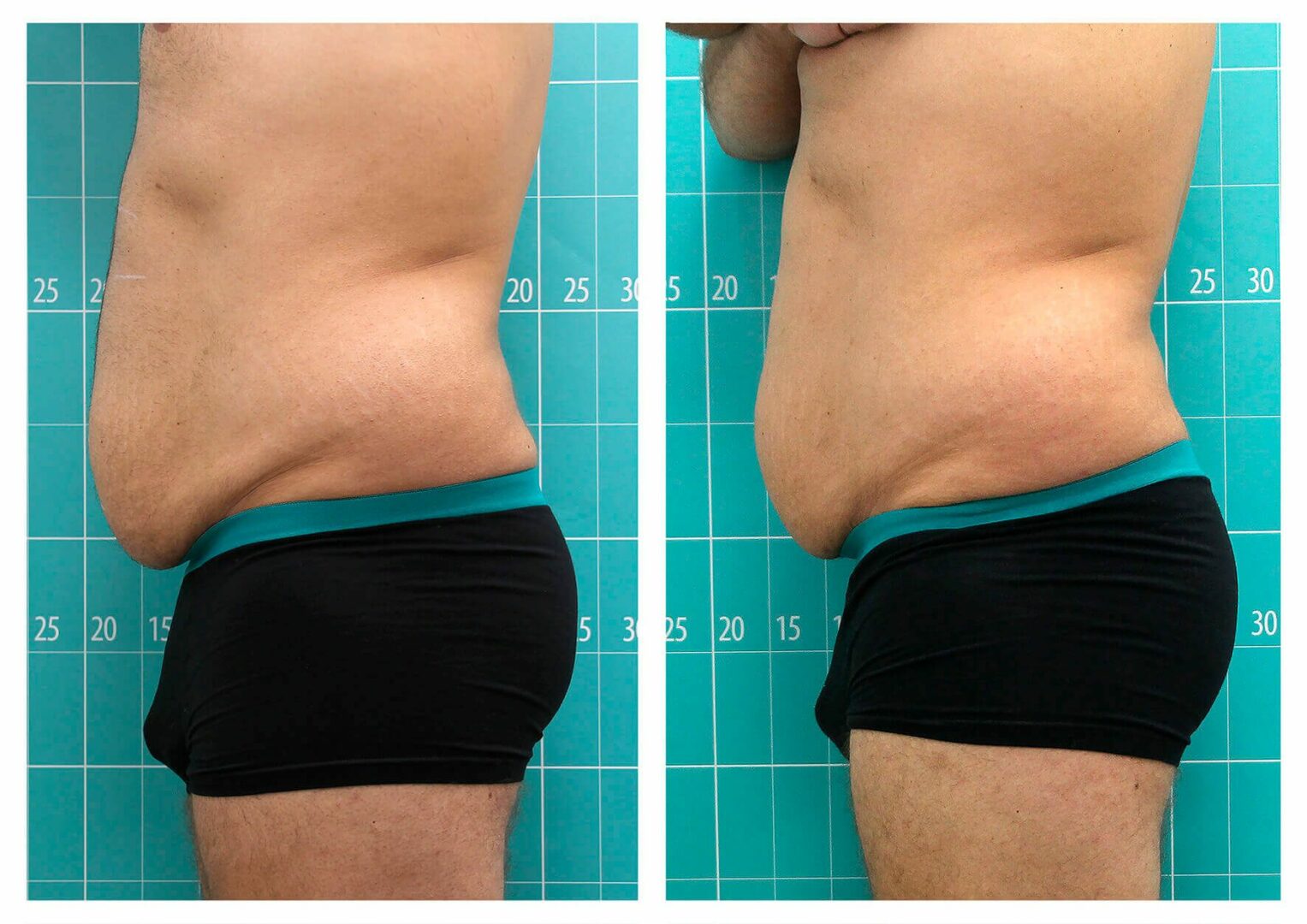 Tratamento da gordura abdominal | 3 sessões
