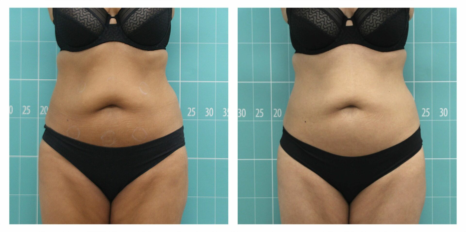 Abdomen treatment: 8 sessions