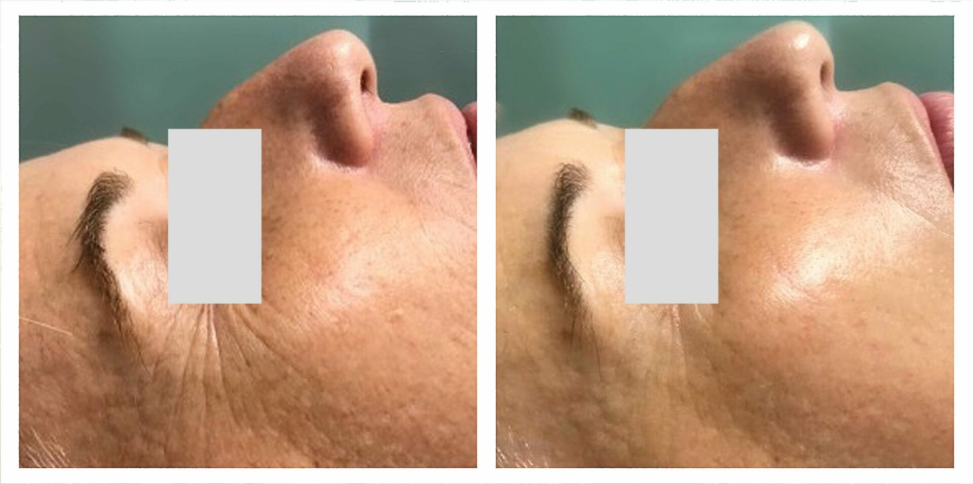 Eye contour rejuvenation | 3 sessions