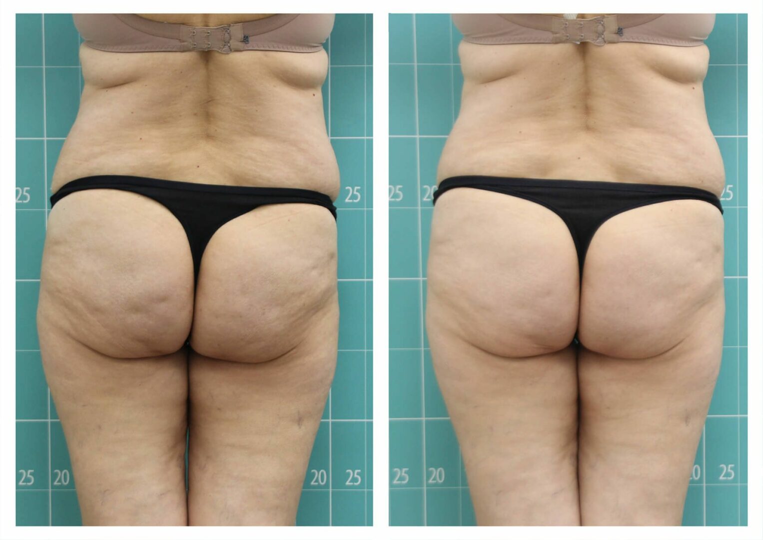 Legs and buttocks treatment | 8 sesiones