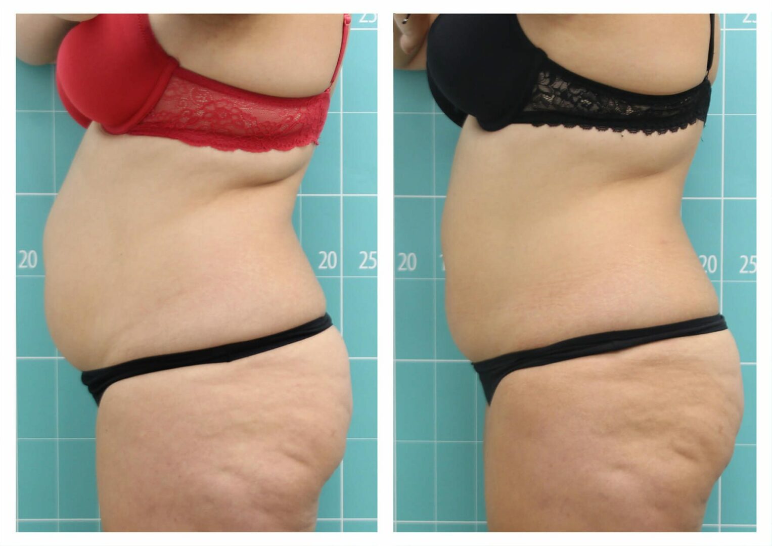 Abdomen treatment | 8 sessions