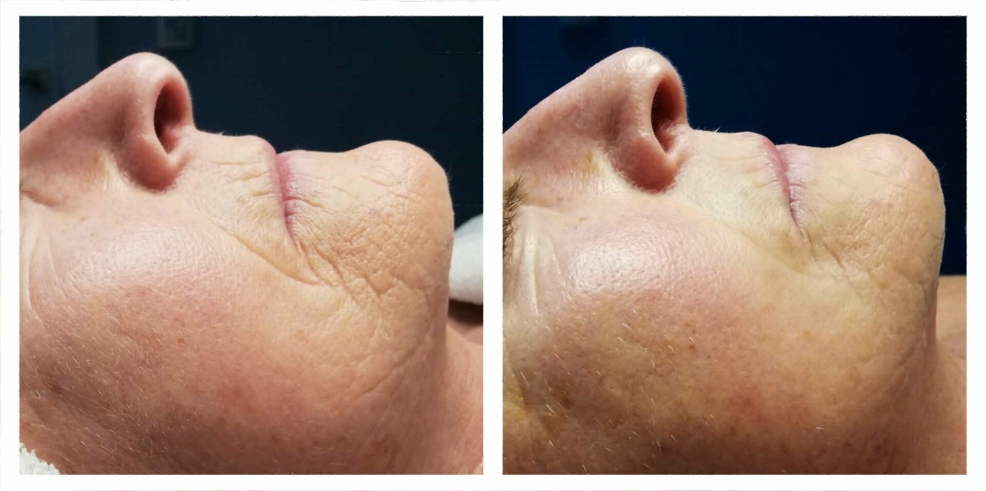 Anti-ageing treatment: 3 sessions