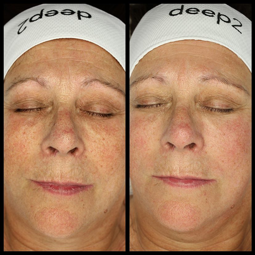 58 year old woman : Anti-ageing treatment