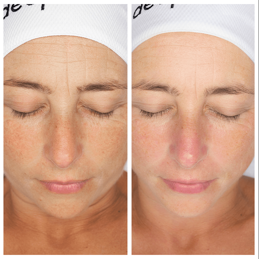 40-year-old : Deep Moisturising Treatment
