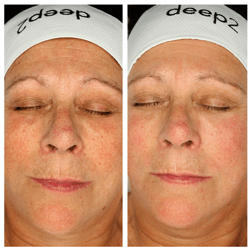58-year-old woman : Anti-ageing treatment