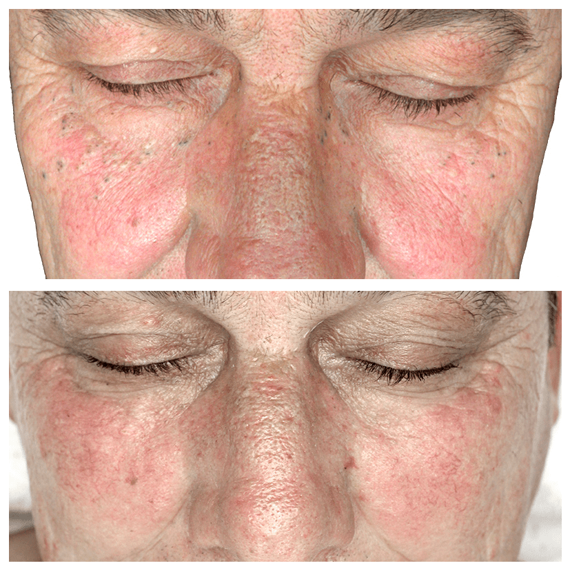 70-year-old man : Deep hygienic treatment