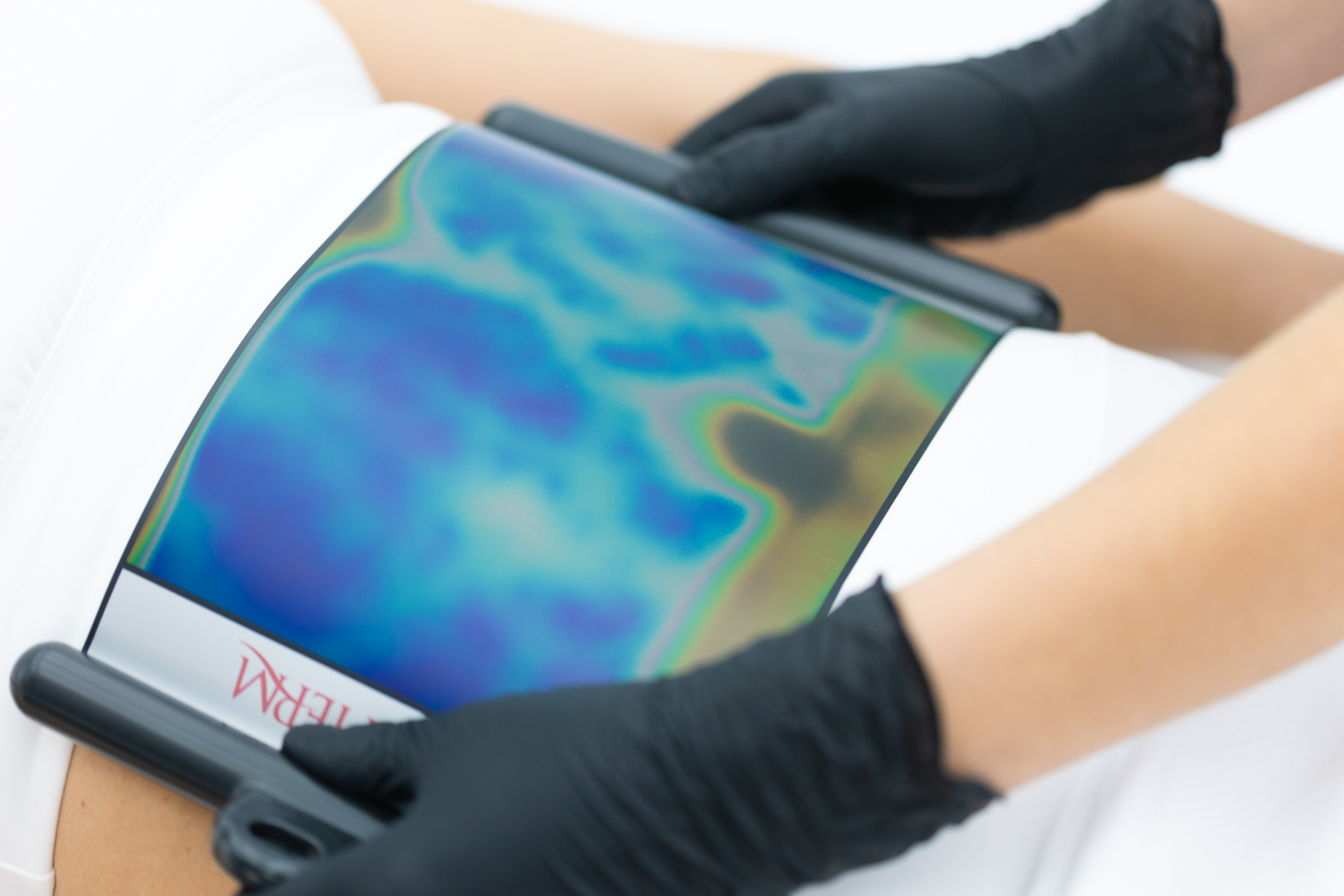 Thermographic picture. Evaluation of fat tissue and abdominal irrigation.