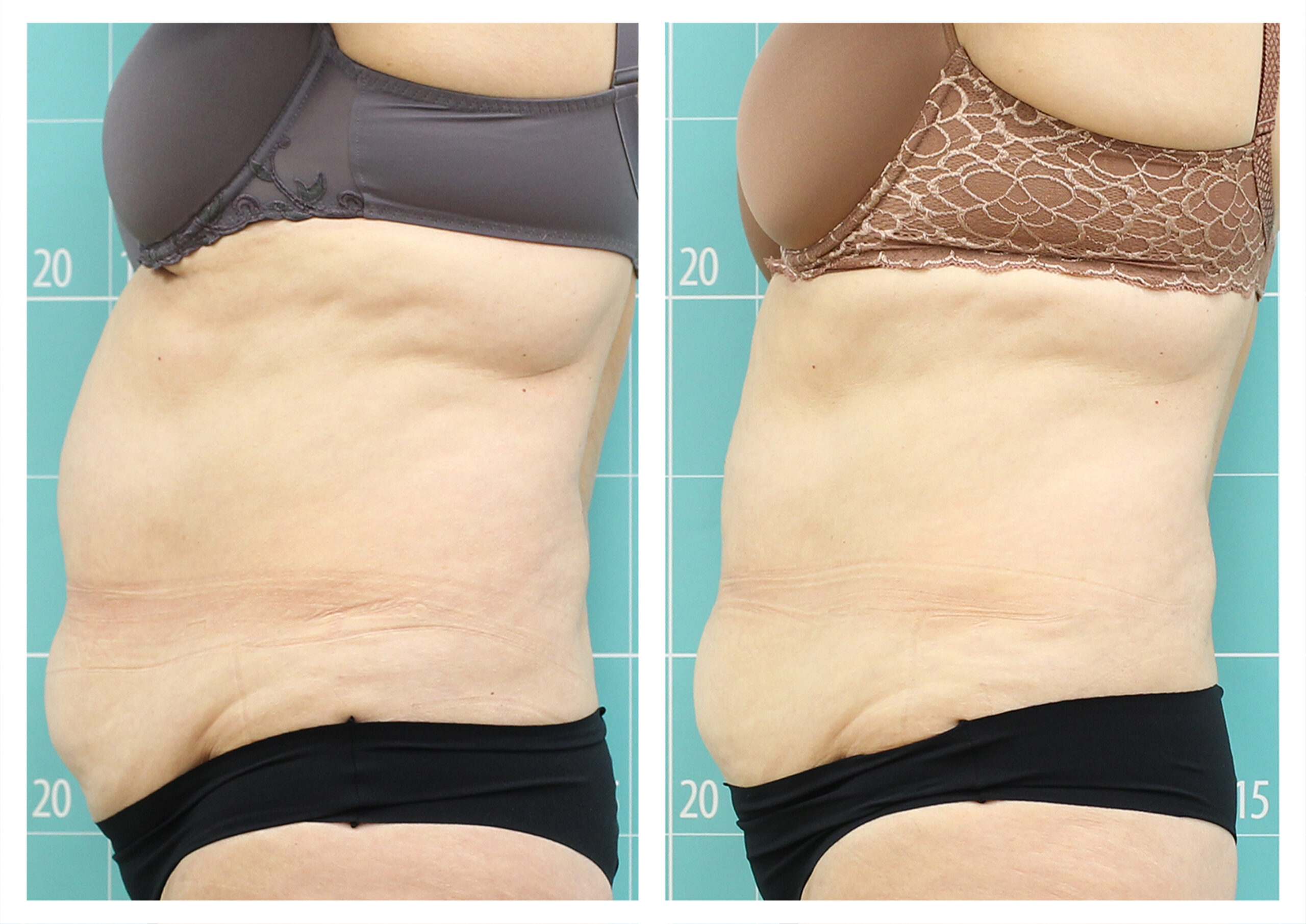 Zionic: Reducción de la adiposidad en abdomen y flancos. 8 sesiones. Clínica Termosalud