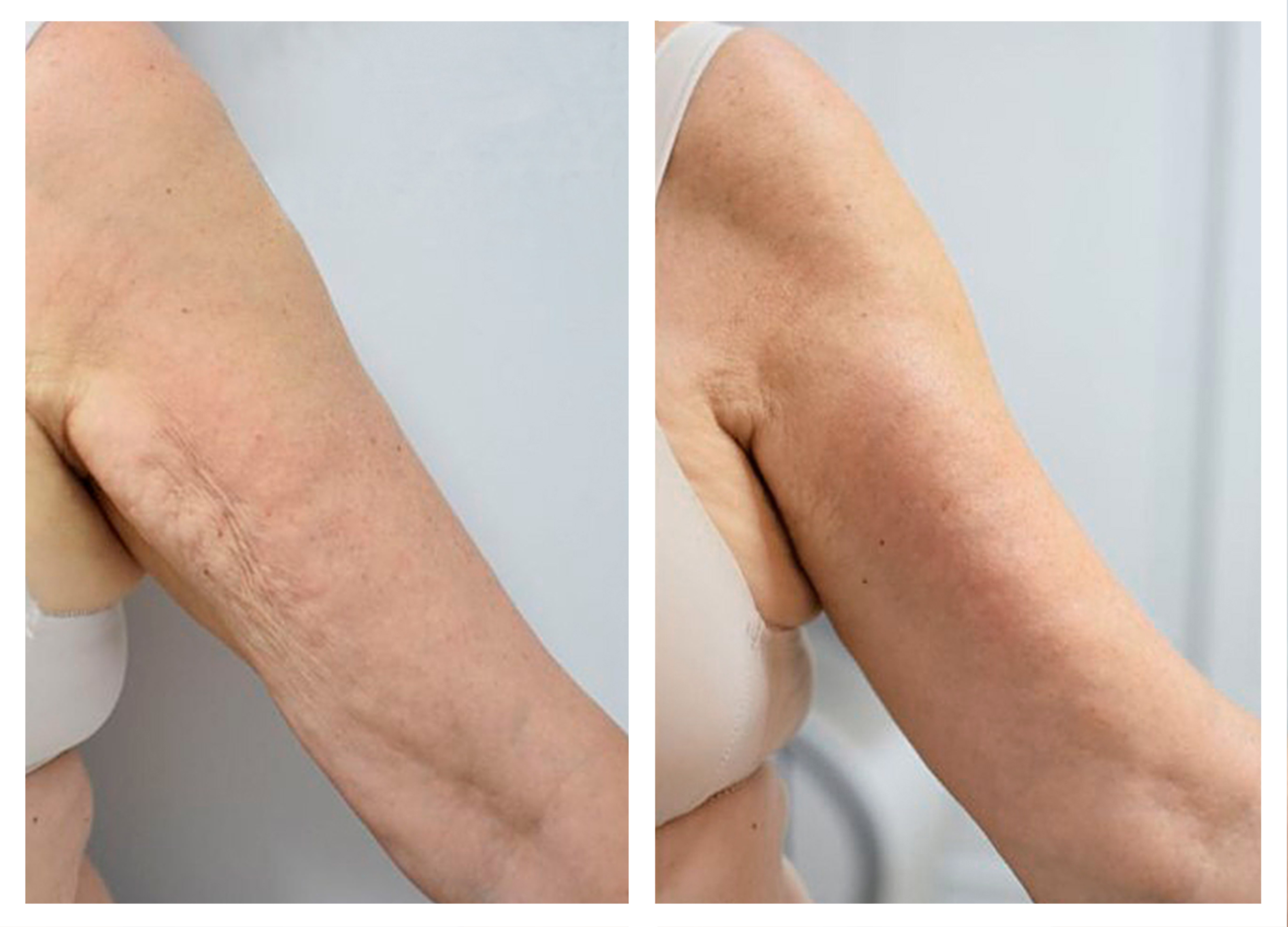Combinación de Symmed y Zionic: Tratamiento reafirmante de brazos. Alma Clinic