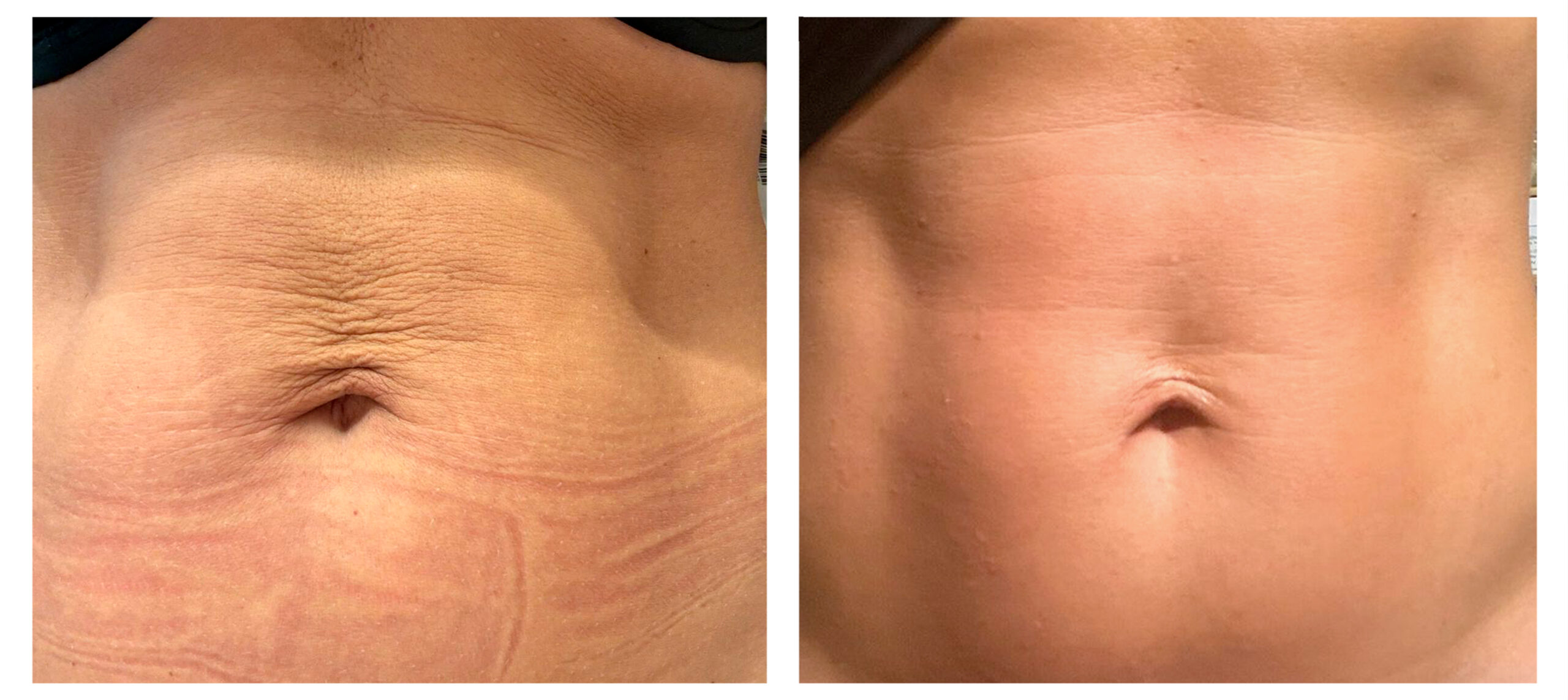 Zionic: Tratamiento reafirmante de abdomen. 1 sesión. Clínica Termosalud
