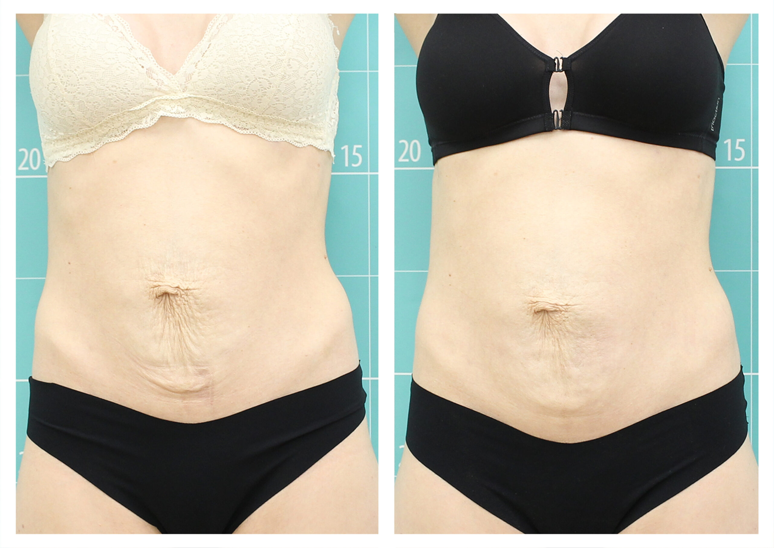 Symmed: Reducción de la flacidez abdominal postparto. 8 sesiones. Clínica Termosalud y Centro Wellness Core