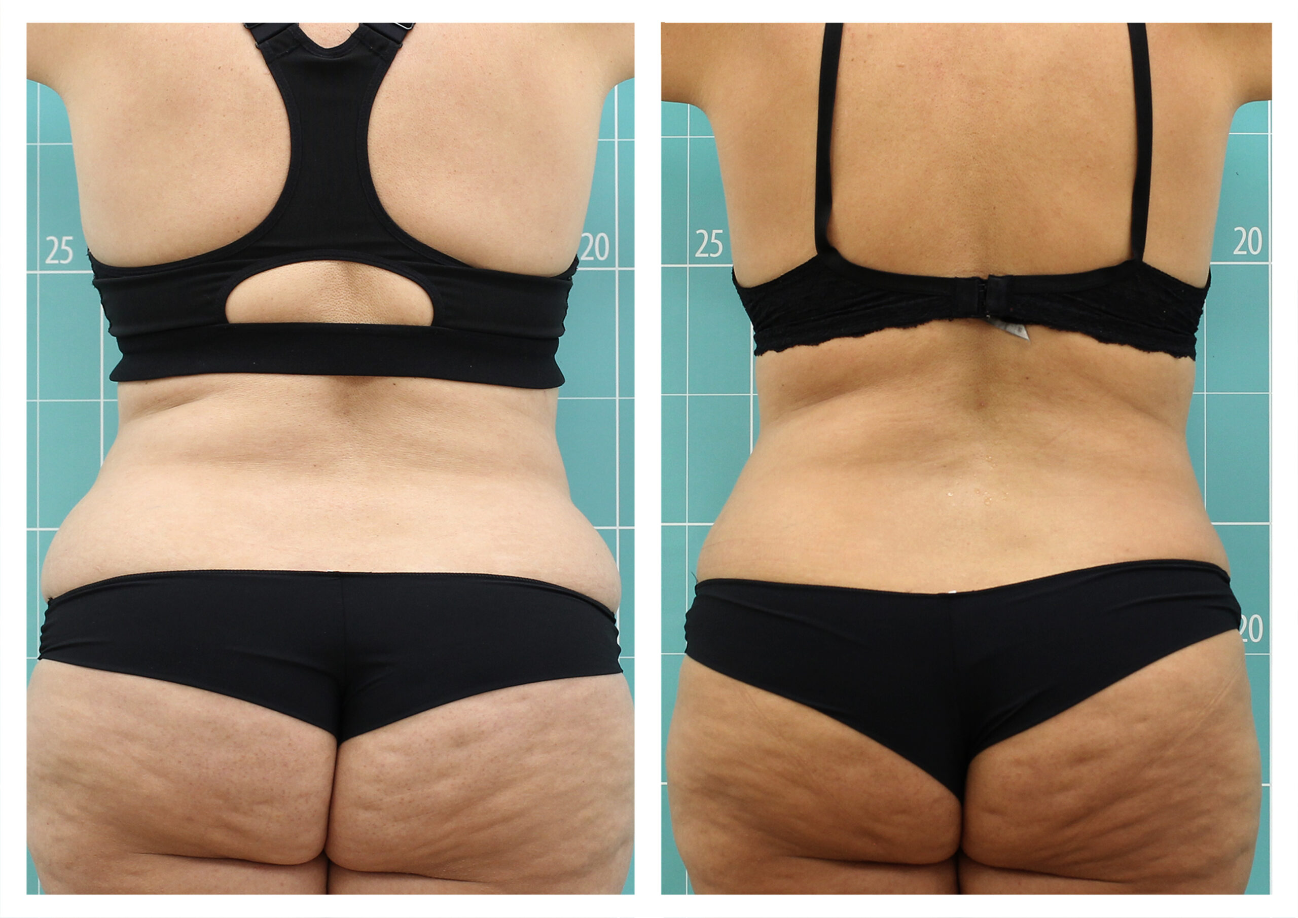 Abdominal adiposity treatment | 4 sessions