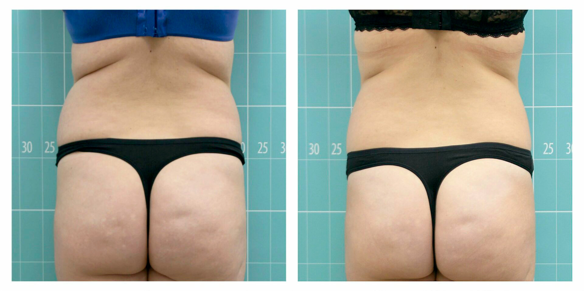 Low waist treatment | 8 sessions