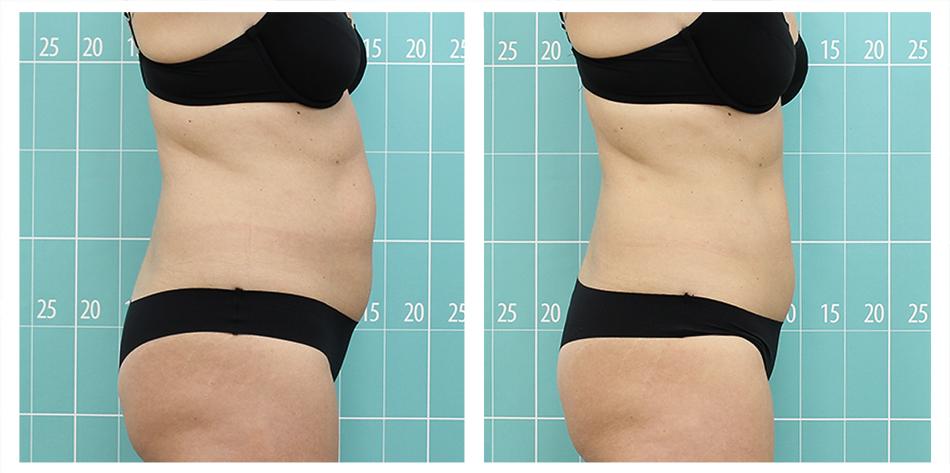 Abdomen treatment | 8 sessions