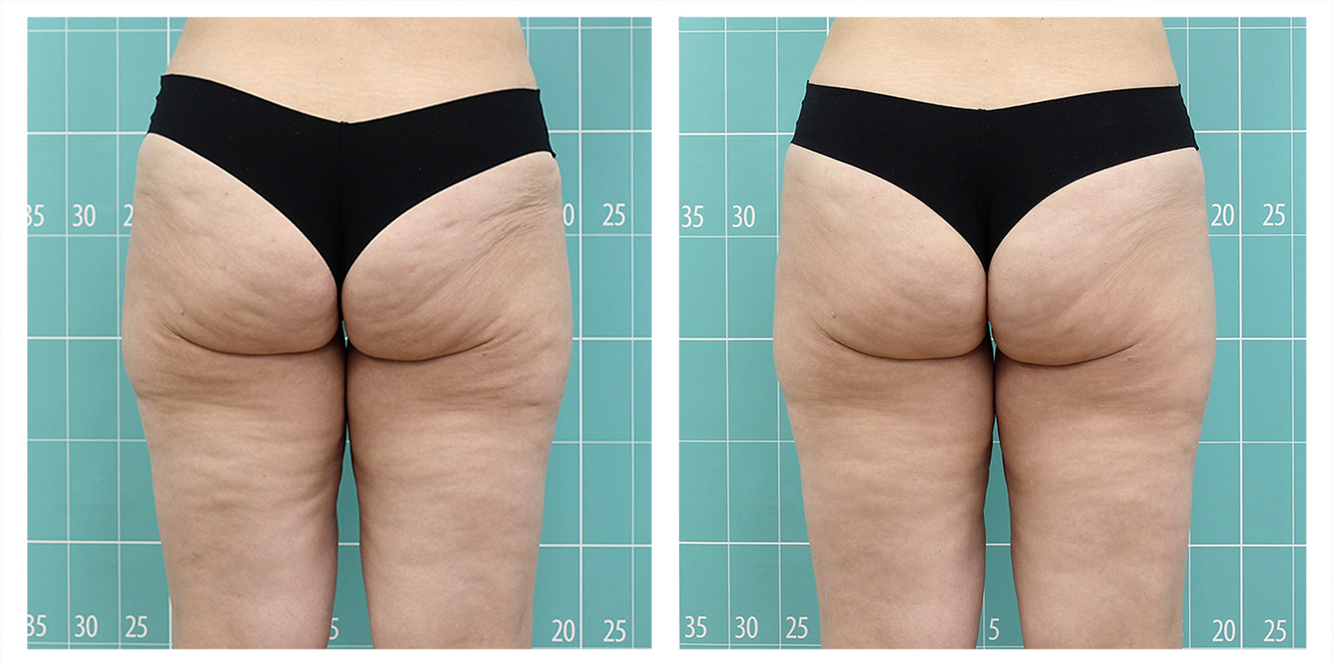 Buttock and thighs treatment | 8 sessions
