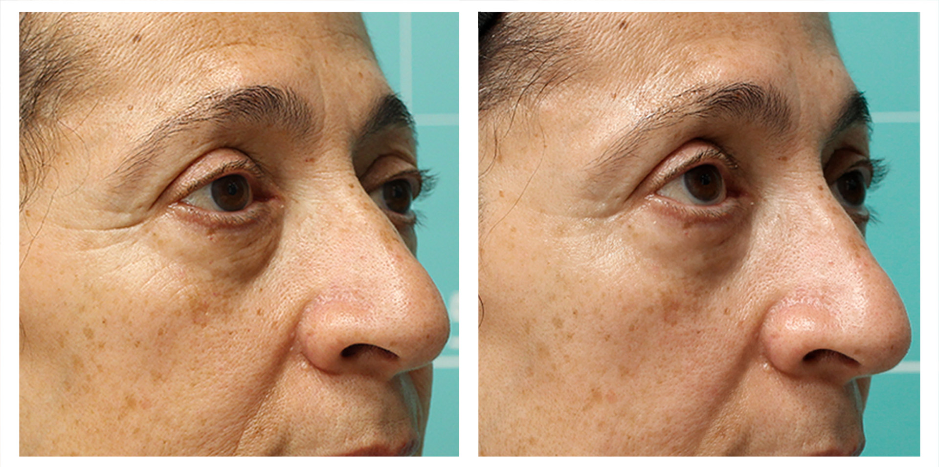 Water bags and eye contour |1 session