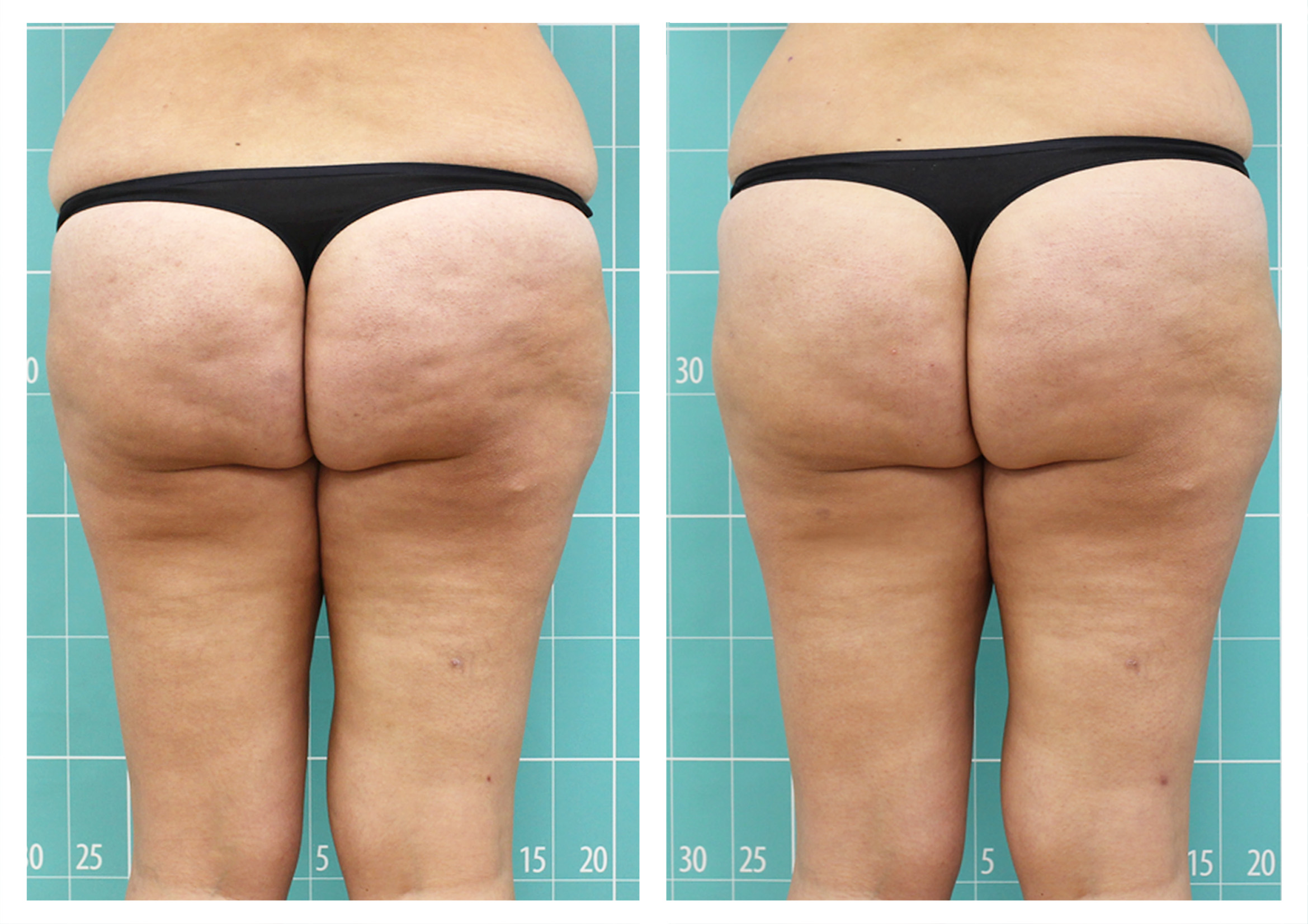 Anti-cellulite treatment | 8 sessions
