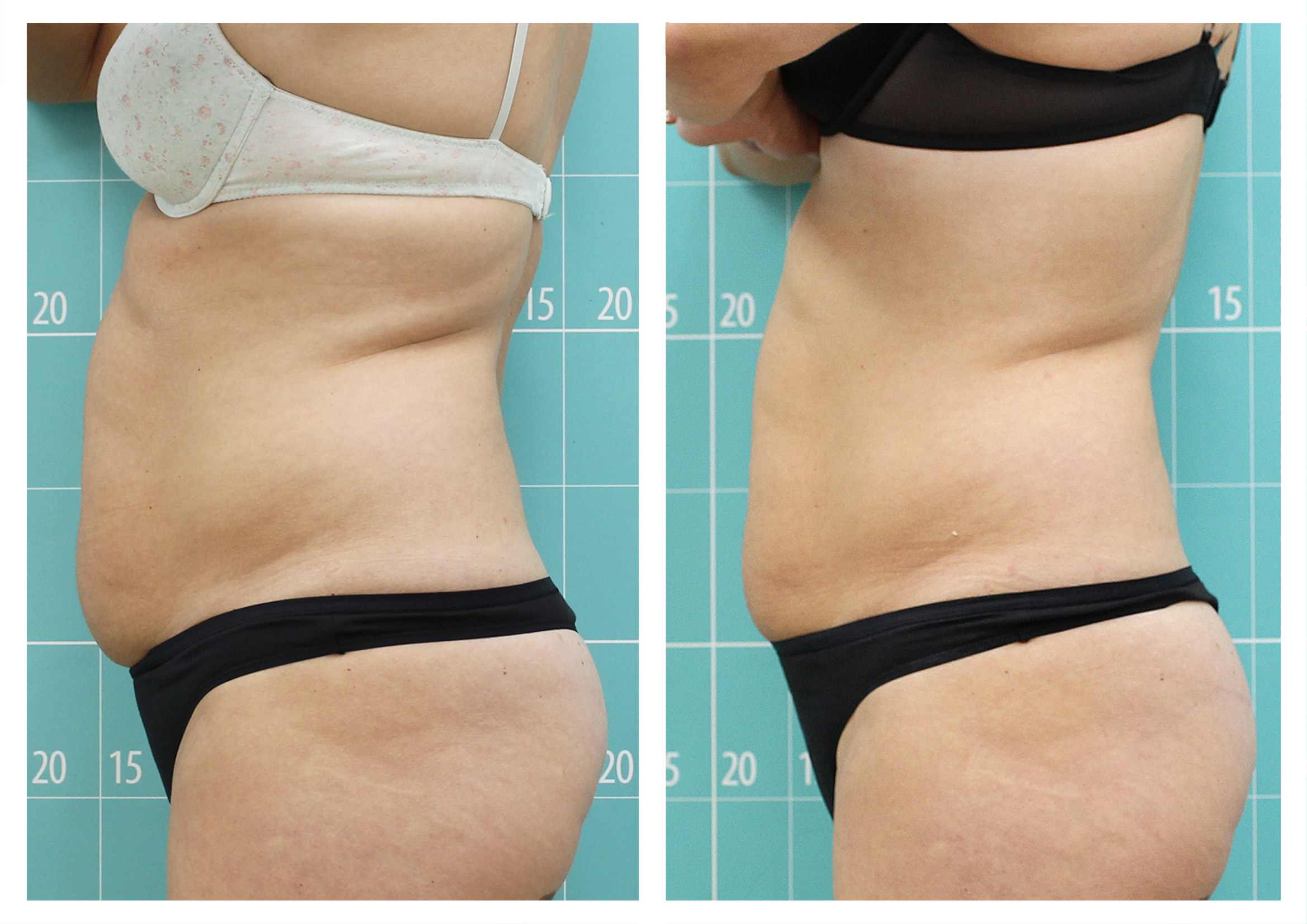 Reduction treatment | 8 sessions