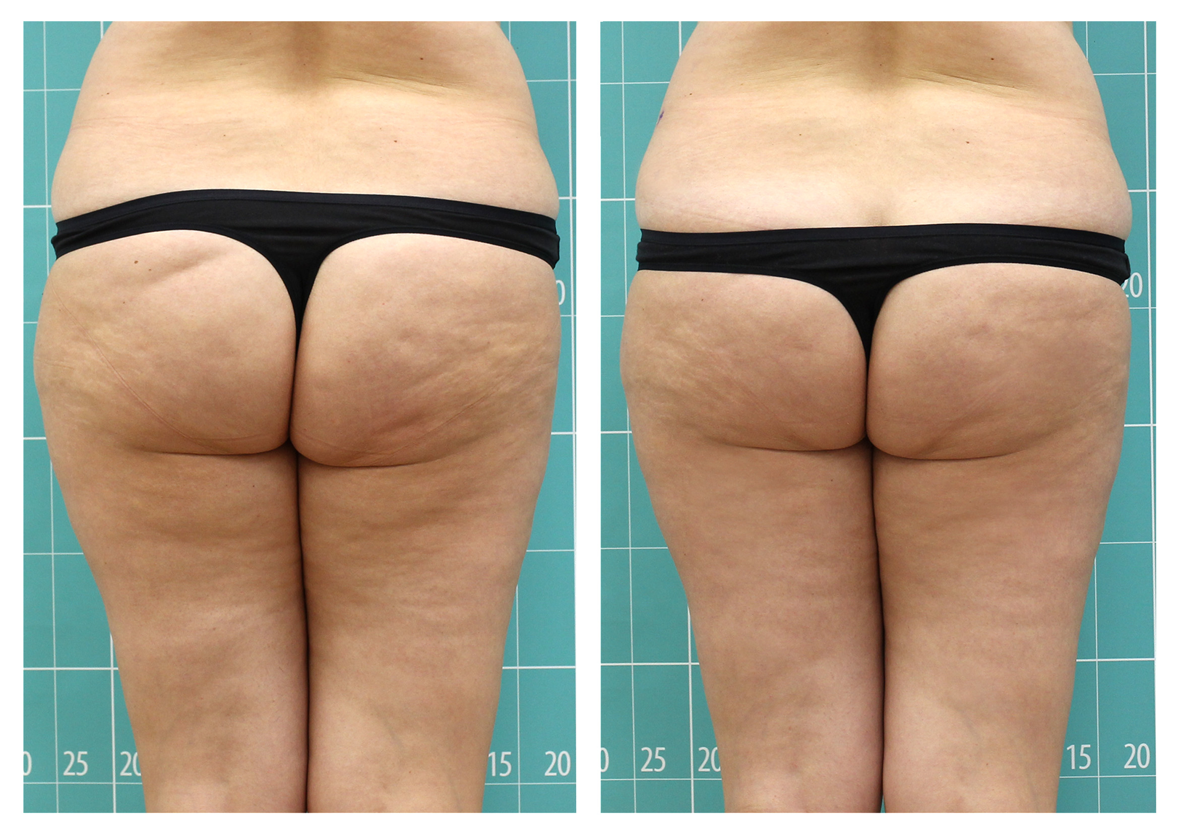 Anti-cellulite treatment | 8 sessions