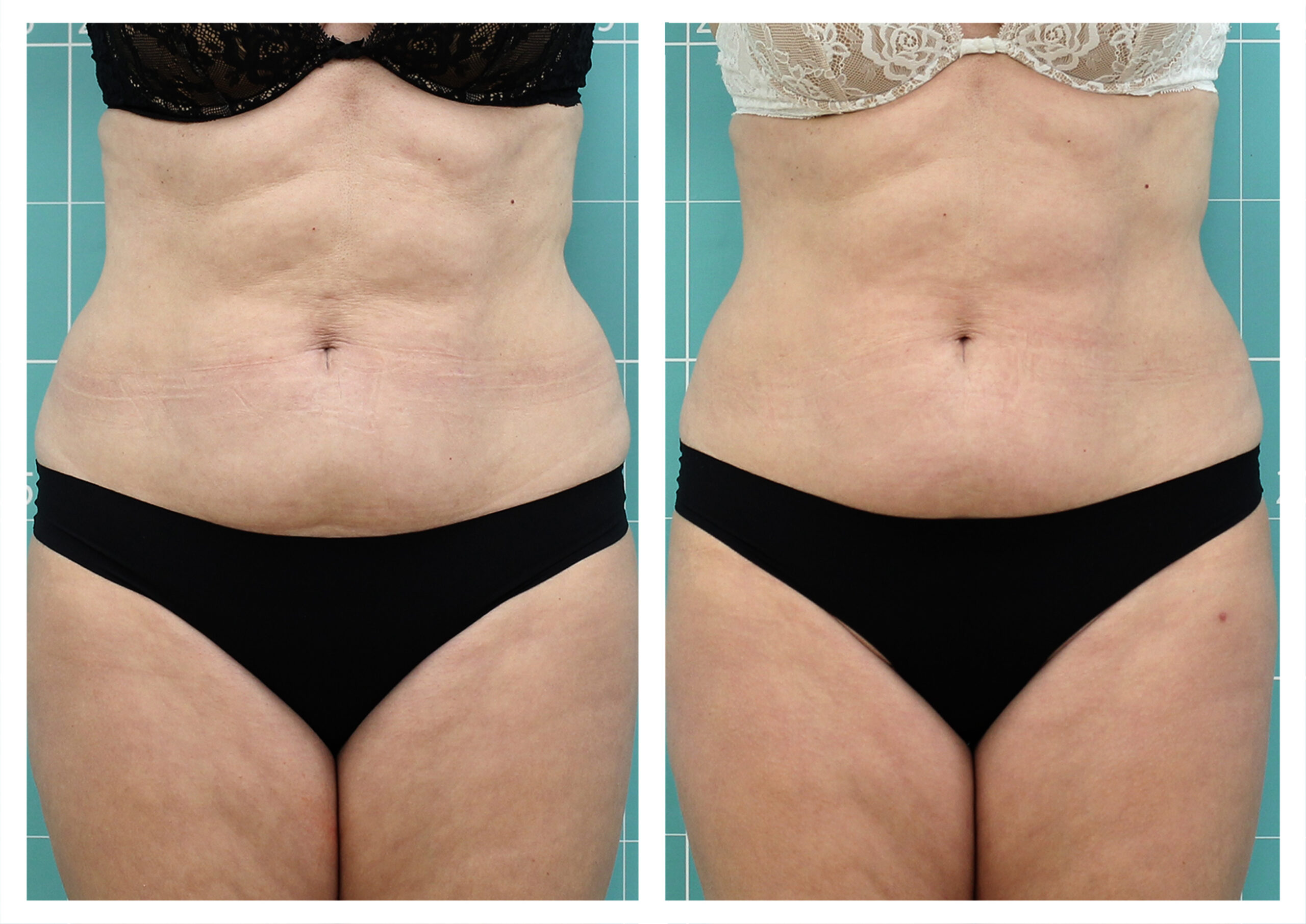 Abdomen treatment | 8 sessions