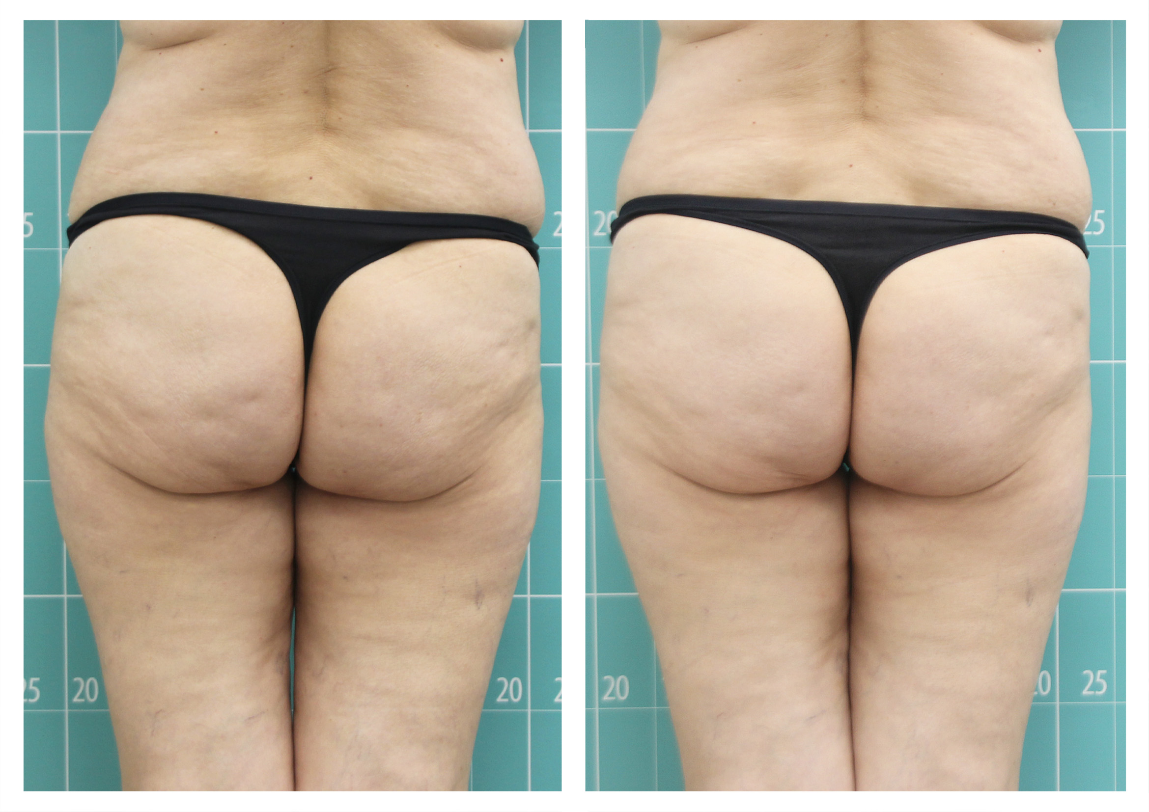 Tighs treatment | 8 sessions.