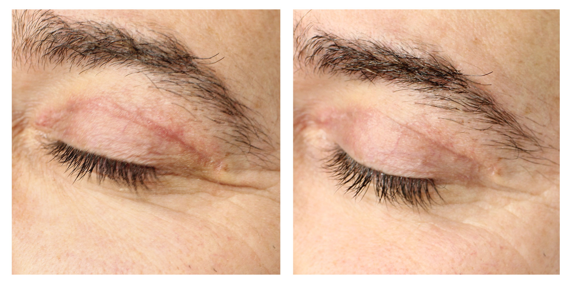 Post-blépharoplastie | 6 séances