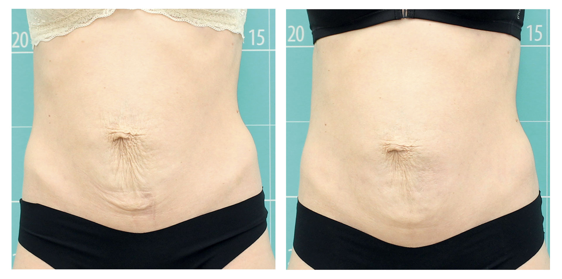 Raffermissement de l’abdomen post triple grossesse | 6 séances