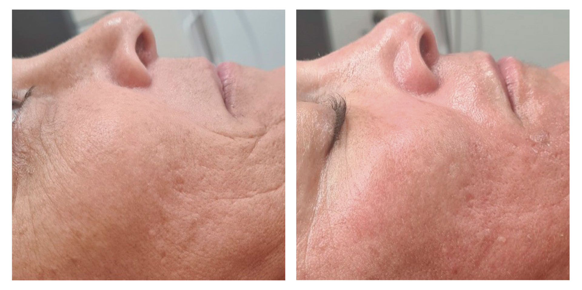 Rajeunissement facial | 1 SÉANCE