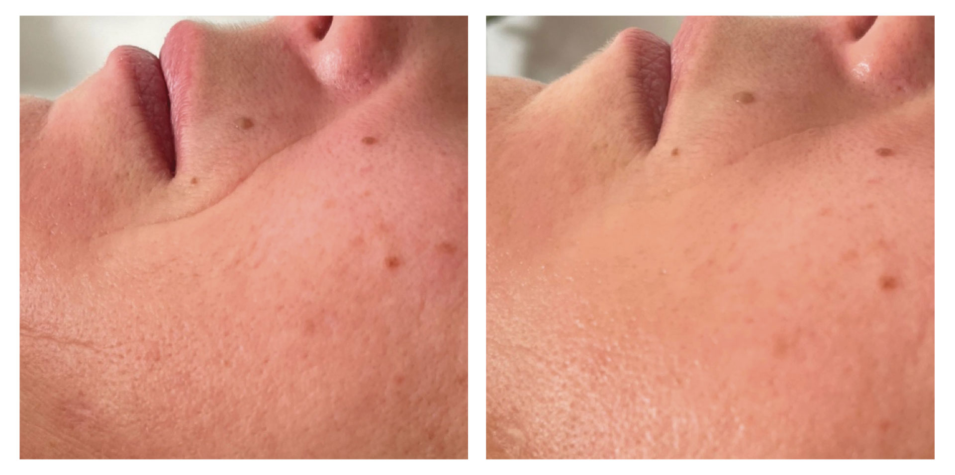 Rajeunissement facial du tiers moyen | 5 SÉANCES